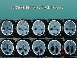 DISGENESIA CALLOSADISGENESIA CALLOSA
 