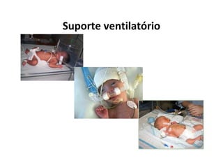 Suporte ventilatório
 