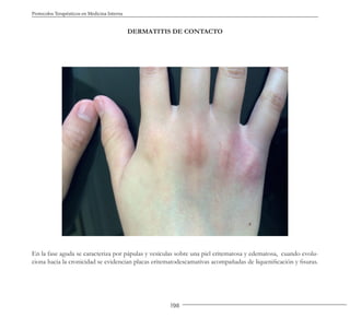 198
Protocolos Terapéuticos en Medicina Interna
DERMATITIS DE CONTACTO
En la fase aguda se caracteriza por pápulas y vesículas sobre una piel eritematosa y edematosa, cuando evolu-
ciona hacia la cronicidad se evidencian placas eritematodescamativas acompañadas de liquenificación y fisuras.
 