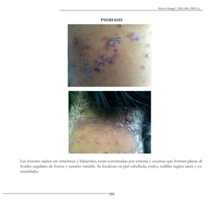 199
Héctor Ortega C. MD, MSc, PhD (c).
PSORIASIS
Las lesiones suelen ser simétricas y bilaterales, están constituidas por eritema y escamas que forman placas de
bordes regulares de forma y tamaño variable. Se localizan en piel cabelluda, codos, rodillas región sacra y ex-
tremidades.
 