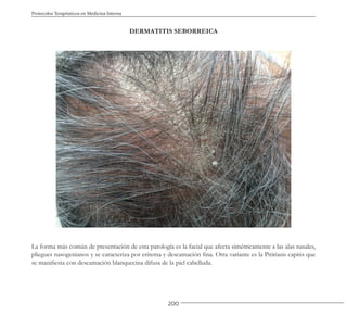 200
Protocolos Terapéuticos en Medicina Interna
DERMATITIS SEBORREICA
La forma más común de presentación de esta patología es la facial que afecta simétricamente a las alas nasales,
pliegues nasogenianos y se caracteriza por eritema y descamación fina. Otra variante es la Pitiriasis capitis que
se manifiesta con descamación blanquecina difusa de la piel cabelluda.
 