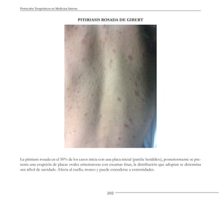 202
Protocolos Terapéuticos en Medicina Interna
PITIRIASIS ROSADA DE GIBERT
La pitiriasis rosada en el 50% de los casos inicia con una placa inicial (parche heráldico), posteriormente se pre-
senta una erupción de placas ovales eritematosas con escamas finas, la distribución que adoptan se denomina
«en árbol de navidad». Afecta al cuello, tronco y puede extenderse a extremidades.
 
