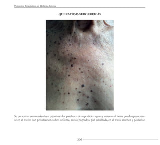 206
Protocolos Terapéuticos en Medicina Interna
QUERATOSIS SEBORREICAS
Se presentan como máculas o pápulas color parduzco de superficie rugosa y untuosa al tacto, pueden presentar-
se en el rostro con predilección sobre la frente, en los párpados, piel cabelluda, en el tórax anterior y posterior.
 