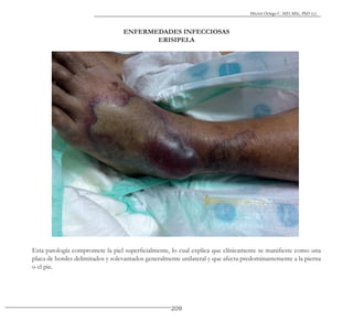 209
Héctor Ortega C. MD, MSc, PhD (c).
ENFERMEDADES INFECCIOSAS
ERISIPELA
Esta patología compromete la piel superficialmente, lo cual explica que clínicamente se manifieste como una
placa de bordes delimitados y solevantados generalmente unilateral y que afecta predominantemente a la pierna
o el pie.
 