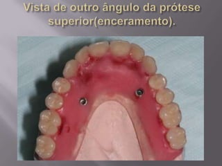 Protocolo superior e inferior.