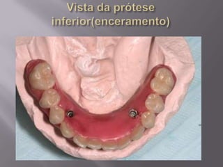 Protocolo superior e inferior.