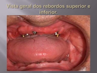 Protocolo superior e inferior.