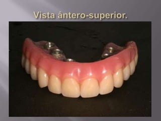 Protocolo superior e inferior.