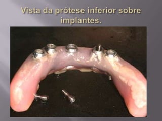 Protocolo superior e inferior.