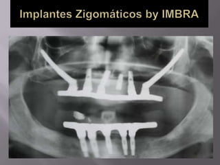 Protocolo superior e inferior.