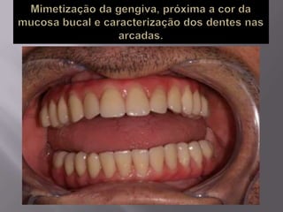 Protocolo superior e inferior.