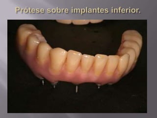 Protocolo superior e inferior.