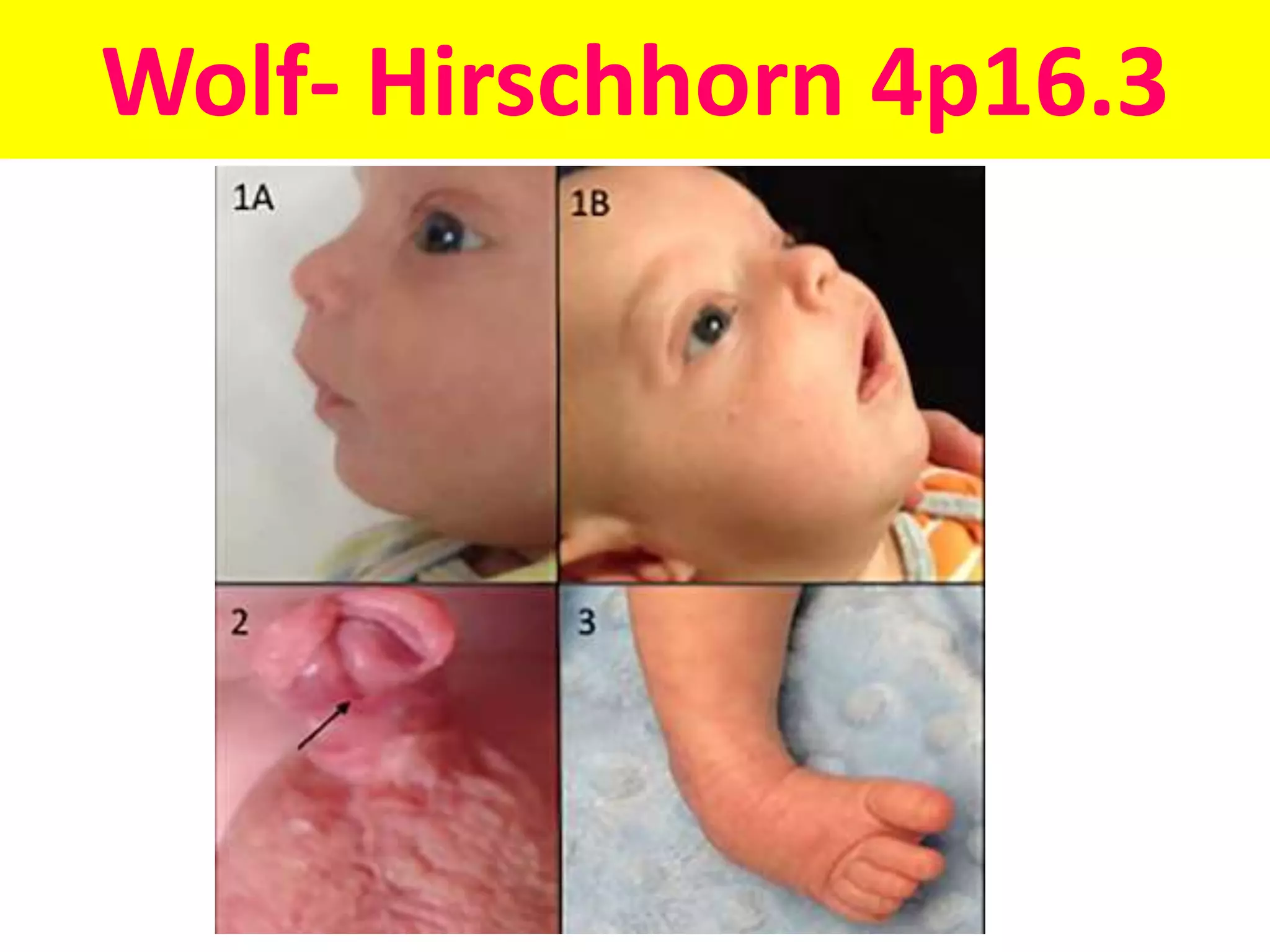 glimpses-of-syndromes-of-chromosomal-abnormalities-genetic-diseases