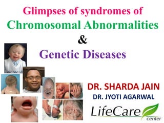 Glimpses of syndromes of
Chromosomal Abnormalities
&
Genetic Diseases
DR. SHARDA JAIN
DR. JYOTI AGARWAL
 