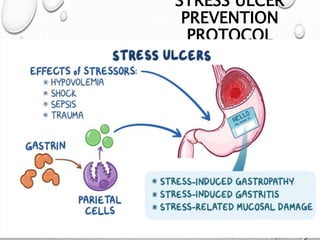 STRESS ULCER
PREVENTION
PROTOCOL
 