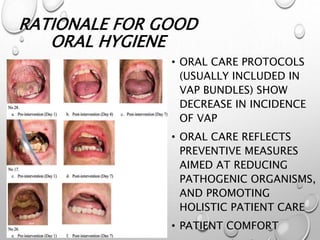 RATIONALE FOR GOOD
ORAL HYGIENE
• ORAL CARE PROTOCOLS
(USUALLY INCLUDED IN
VAP BUNDLES) SHOW
DECREASE IN INCIDENCE
OF VAP
• ORAL CARE REFLECTS
PREVENTIVE MEASURES
AIMED AT REDUCING
PATHOGENIC ORGANISMS,
AND PROMOTING
HOLISTIC PATIENT CARE
• PATIENT COMFORT
 