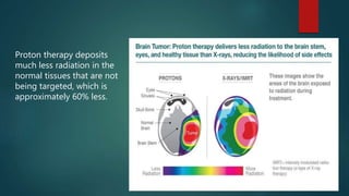Proton therapy deposits
much less radiation in the
normal tissues that are not
being targeted, which is
approximately 60% less.
 
