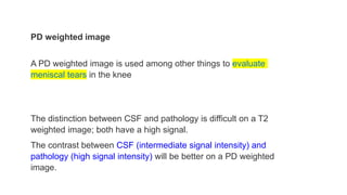 PD weighted image
A PD weighted image is used among other things to evaluate
meniscal tears in the knee
The distinction between CSF and pathology is difficult on a T2
weighted image; both have a high signal.
The contrast between CSF (intermediate signal intensity) and
pathology (high signal intensity) will be better on a PD weighted
image.
 
