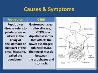 Causes & Symptoms
Peptic Ulcer GERD
Peptic ulcer
disease refers to
painful sores or
ulcers in the
lining of
the stomach or
first part of the
small intestine,
called the
duodenum.
Gastroesophageal
reflux disease,
or GERD, is a
digestive disorder
that affects the
lower esophageal
sphincter (LES),
the ring of muscle
between
the esophagus and
stomach.
 