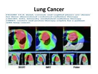 Lung Cancer
 