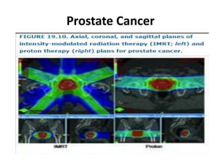 Prostate Cancer
 