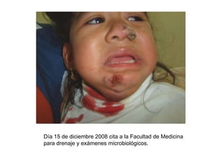 Día 15 de diciembre 2008 cita a la Facultad de Medicina para drenaje y exámenes microbiológicos. 