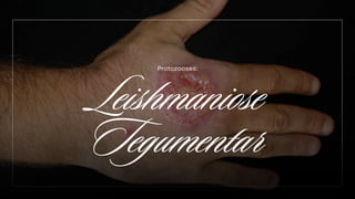Leishmaniose
Tegumentar
Protozooses:
 