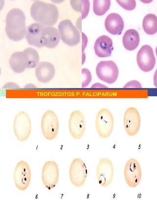 TROFOZOITOS P. FALCIPARUM 