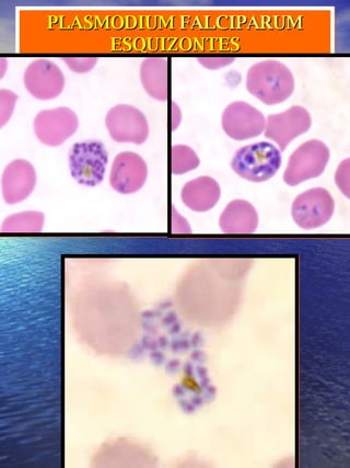 PLASMODIUM  FALCIPARUM ESQUIZONTES 