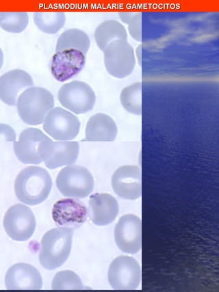 PLASMODIUM MALARIE GAMETOCITOS 