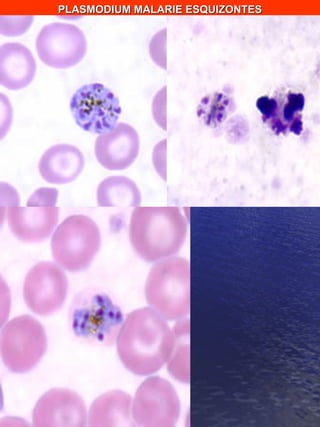 PLASMODIUM MALARIE ESQUIZONTES 