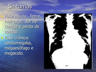 Sintomas Fase aguda:, febre, mal-estar, dor de cabeça e perda de apetite. Fase crônica: cardiomegalia, megaesôfago e megacolo. 