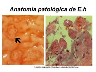 FUNDACION BAARCELO FACULTAD DE MEDICINA
Anatomía patológica de E.h
 