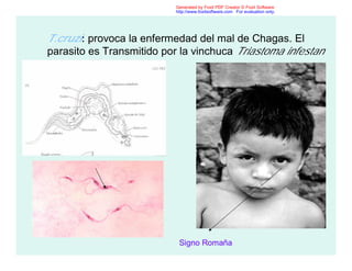 T.cruzi: provoca la enfermedad del mal de Chagas. El
parasito es Transmitido por la vinchuca Triastoma infestan
•
Signo Romaña
Generated by Foxit PDF Creator © Foxit Software
http://www.foxitsoftware.com For evaluation only.
 