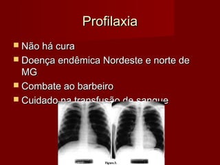Profilaxia
 Não há cura
 Doença endêmica Nordeste e norte de
  MG
 Combate ao barbeiro
 Cuidado na transfusão de sangue
 