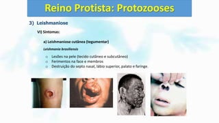 3) Leishmaniose
VI) Sintomas:
a) Leishmaniose cutânea (tegumentar)
Leishmania brasiliensis
o Lesões na pele (tecido cutâneo e subcutâneo)
o Ferimentos na face e membros
o Destruição do septo nasal, lábio superior, palato e faringe.
Reino Protista: Protozooses
 