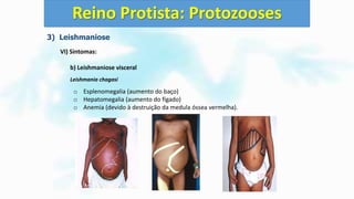 3) Leishmaniose
VI) Sintomas:
b) Leishmaniose visceral
Leishmania chagasi
o Esplenomegalia (aumento do baço)
o Hepatomegalia (aumento do fígado)
o Anemia (devido à destruição da medula óssea vermelha).
Reino Protista: Protozooses
 