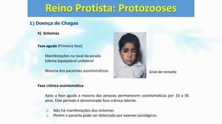 1) Doença de Chagas
h) Sintomas
Fase aguda (Primeira fase)
Manifestações no local da picada
Edema bipalpebral unilateral
Maioria dos pacientes assintomáticos
Fase crônica assintomática
Após a fase aguda a maioria das pessoas permanecem assintomáticas por 10 a 30
anos. Este período é denominado fase crônica latente.
o Não há manifestações dos sintomas
o Porém o parasita pode ser detectado por exames sorológicos.
Reino Protista: Protozooses
Sinal de romaña
 