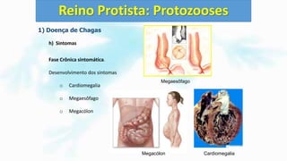 1) Doença de Chagas
h) Sintomas
Fase Crônica sintomática.
Desenvolvimento dos sintomas
o Cardiomegalia
o Megaesôfago
o Megacólon
Reino Protista: Protozooses
Megaesôfago
Megacólon Cardiomegalia
 