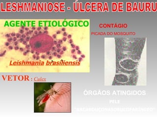 ÓRGÃOS ATINGIDOS PELE “ ARCABOUÇONASOBUCOFARÍNGEO” LESHMANIOSE - ÚLCERA DE BAURU VETOR  :   Culex CONTÁGIO PICADA DO MOSQUITO AGENTE ETIOLÓGICO   Leishmania   brasiliensis 