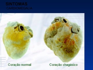 SINTOMAS   CARDIOMEGALIA 