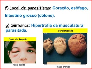 f) Local de parasitismo: Coração, esôfago,
Intestino grosso (cólons).
g) Sintomas: Hipertrofia da musculatura
parasitada.
Sinal de Romaña
Cardiomegalia
Fase aguda
Fase crônica
 