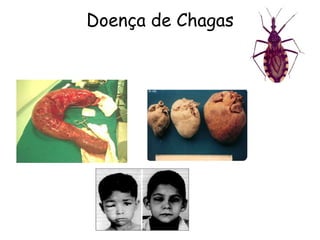 Doença de Chagas
 