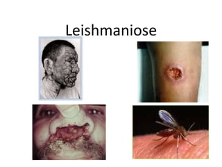Leishmaniose
 