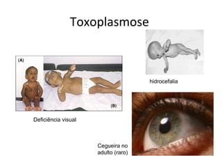 Toxoplasmose



                                     hidrocefalia




Deficiência visual



                     Cegueira no
                     adulto (raro)
 