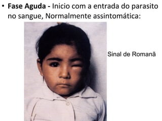 • Fase Aguda - Inicio com a entrada do parasito
  no sangue, Normalmente assintomática:



                               Sinal de Romanã
 