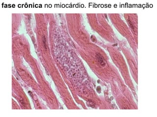fase crônica no miocárdio. Fibrose e inflamação
 