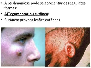 • A Leishmaniose pode se apresentar das seguintes
  formas:
• A)Tegumentar ou cutânea:
• Cutânea: provoca lesões cutâneas
 