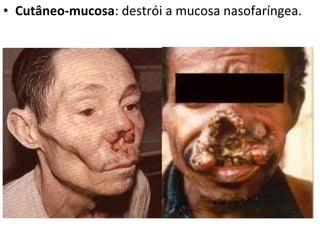 • Cutâneo-mucosa: destrói a mucosa nasofaríngea.
 
