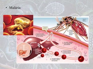 • Malária:
 